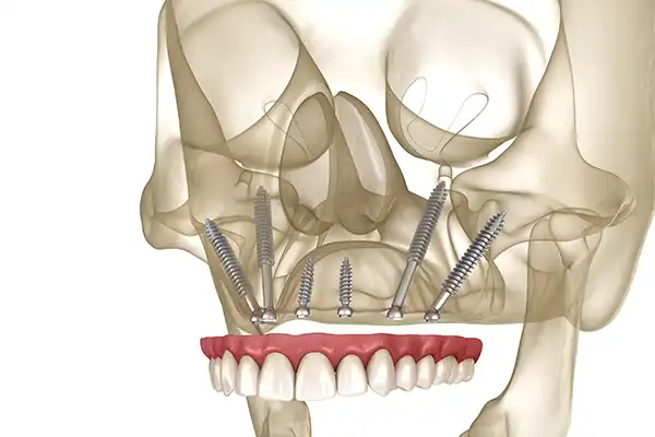 3D x-ray rendering of zygomatic implants placed in the upper jaw